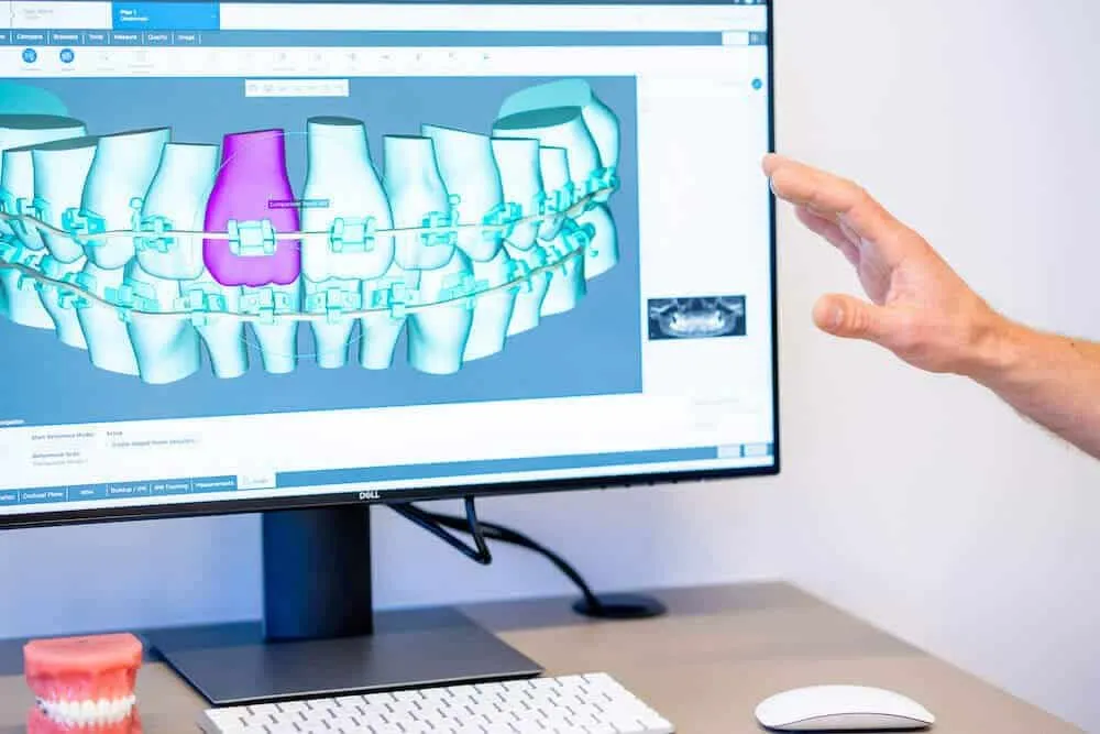 Hand pointing at a screen showing a 3D digital treatment plan with braces on a set of teeth