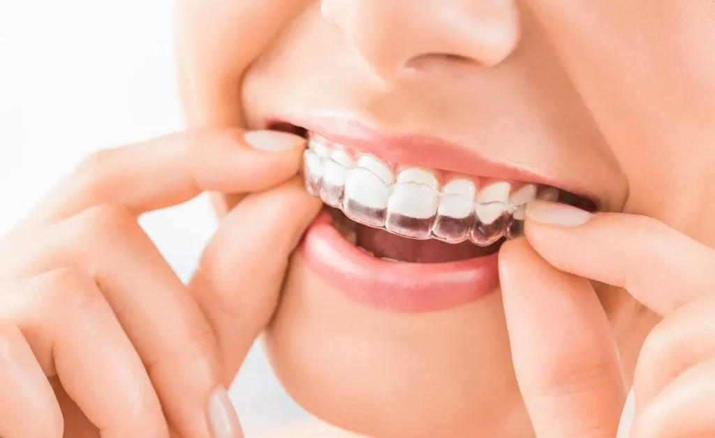 Close-up of a person fitting a clear aligner over their upper teeth