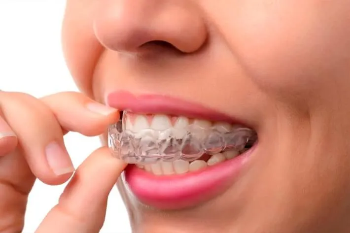 Close-up of a person fitting a clear aligner over their upper teeth