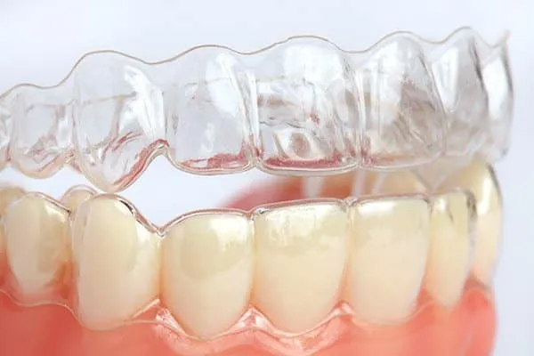 Clear aligner tray fitted over a model of the upper teeth