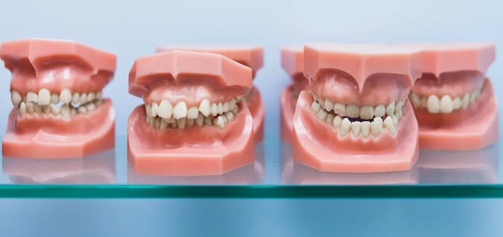 Three dental models showing different types of braces fitted to the teeth