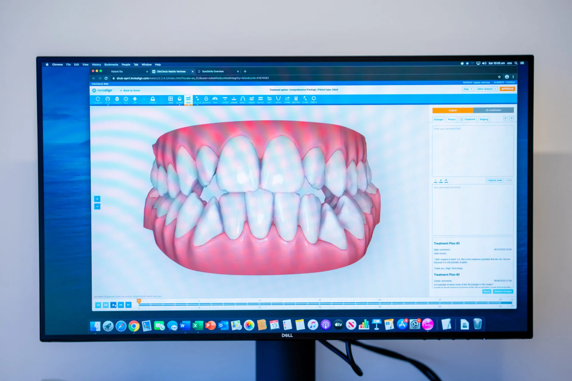 Computer screen showing a 3D digital model of a patient's upper and lower teeth