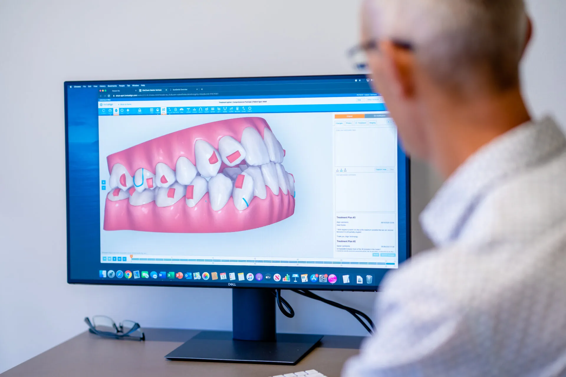 Orthodontist reviewing a 3D digital model of a patient's teeth with braces on a computer screen