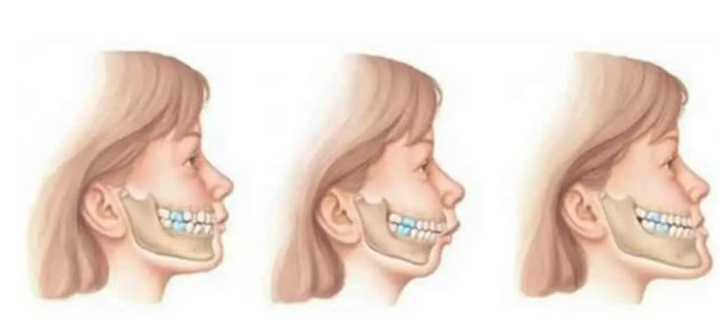Three medical illustrations of a jaw in profile showing the stages of bite correction