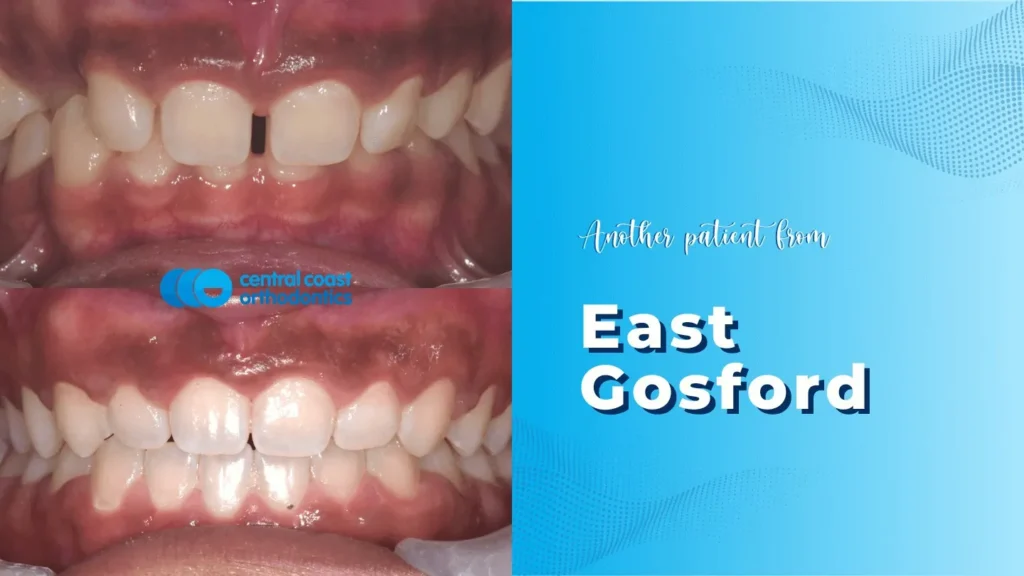 Braces Journey in East Gosford