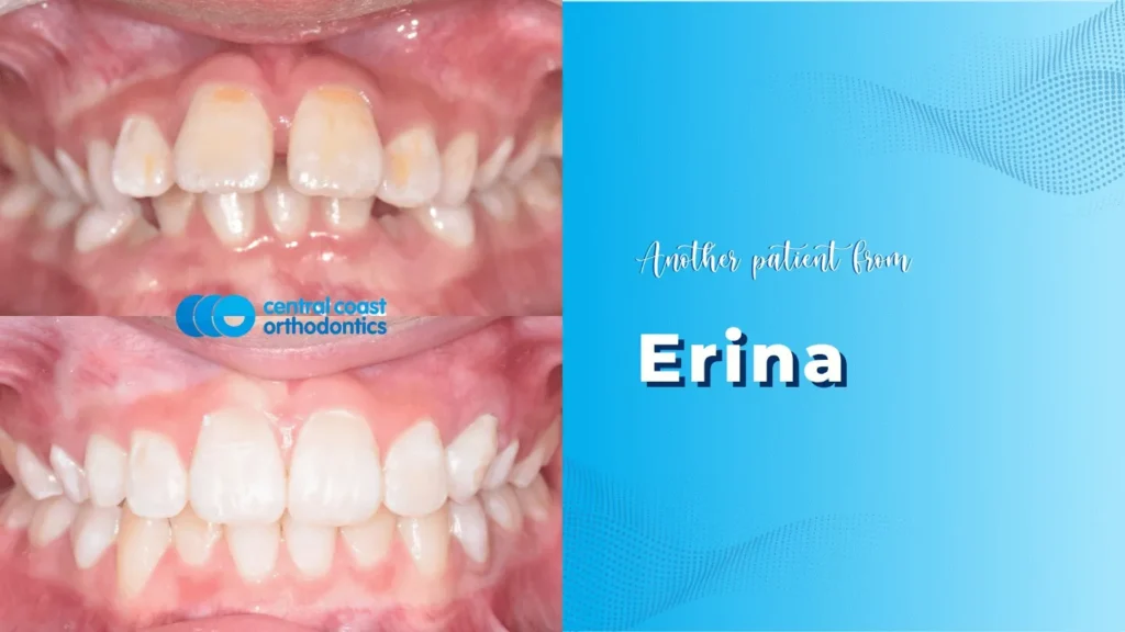 Braces Journey in Erina