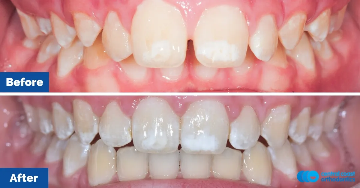 Before and after comparison, front view of the upper and lower teeth