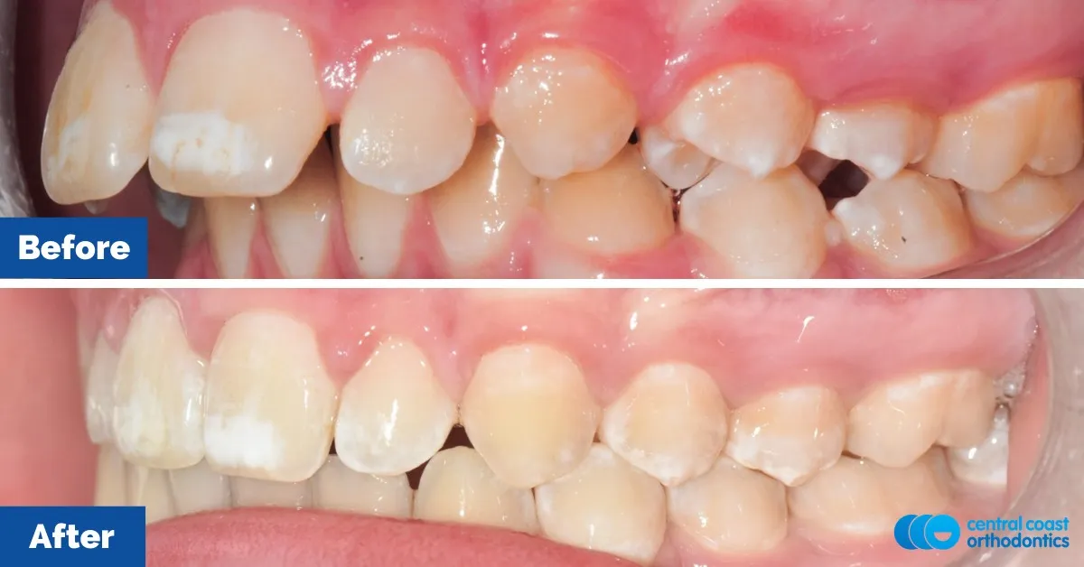 Before and after comparison, side view of the upper and lower teeth