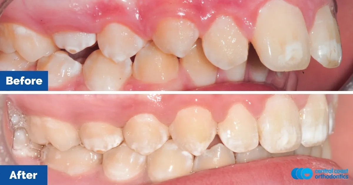 Before and after comparison, side view of the upper and lower teeth