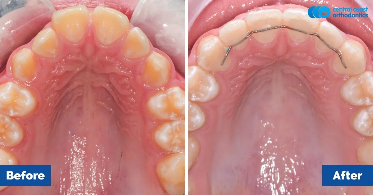 Before and after comparison, upper teeth viewed from below