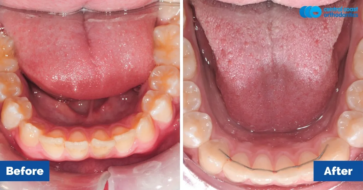 Before and after comparison, lower teeth viewed from above
