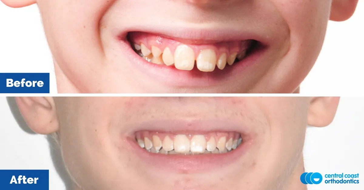 Before and after comparison of the patient's smile