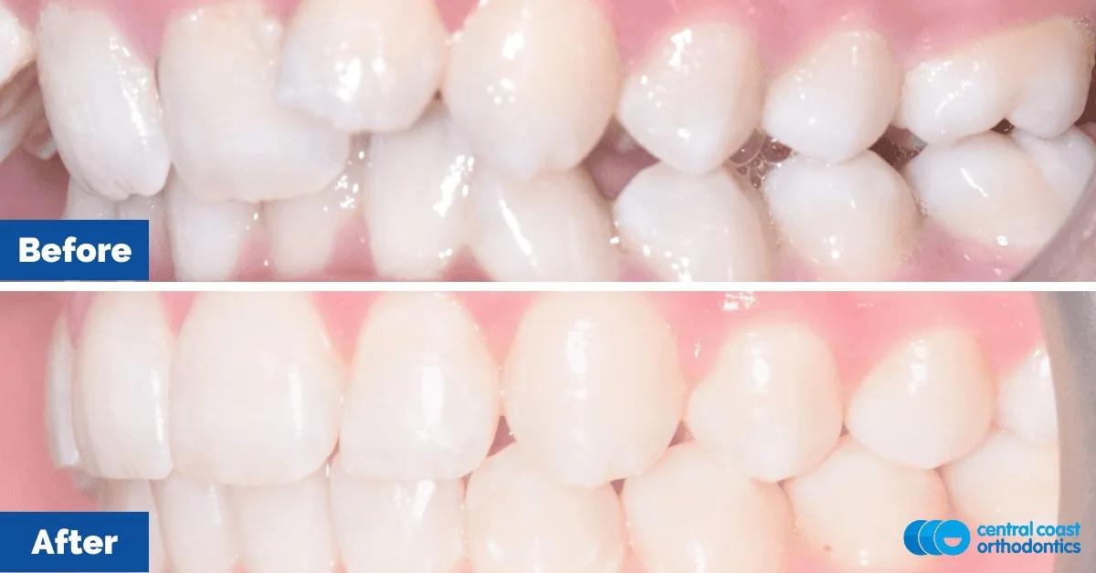 Before and after comparison, front view of the upper and lower teeth