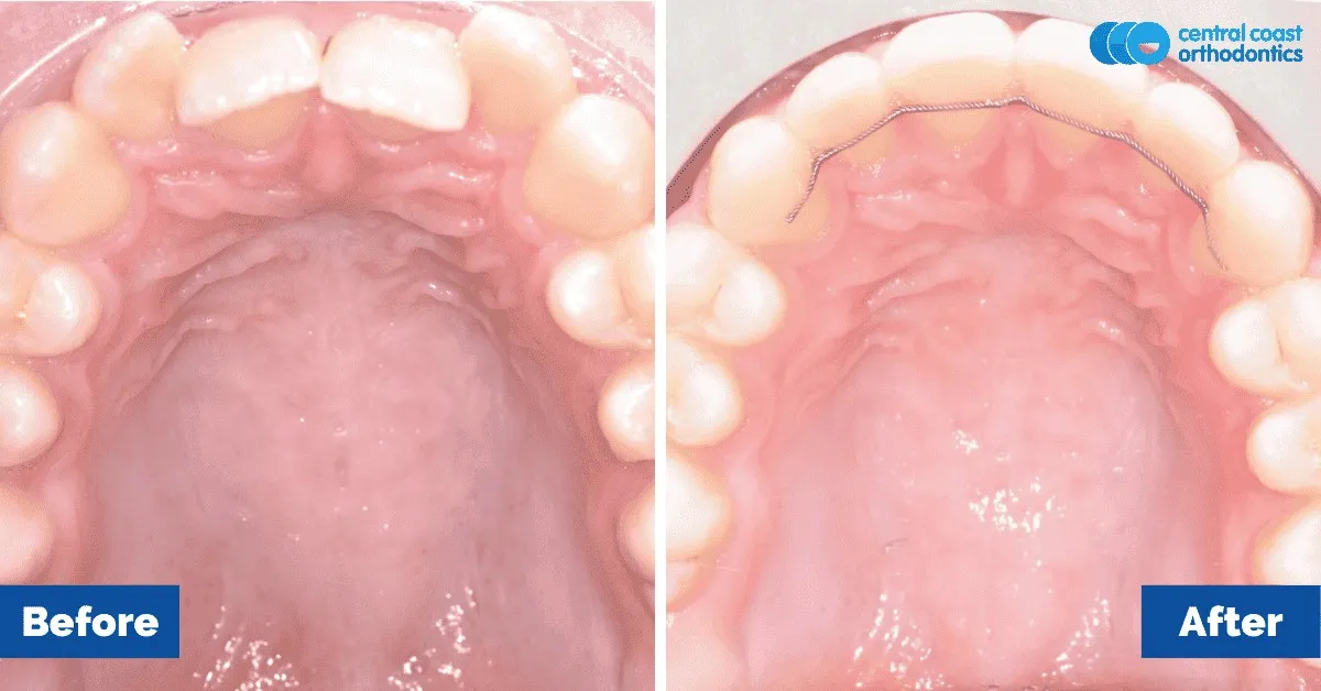 Before and after comparison, upper teeth viewed from below