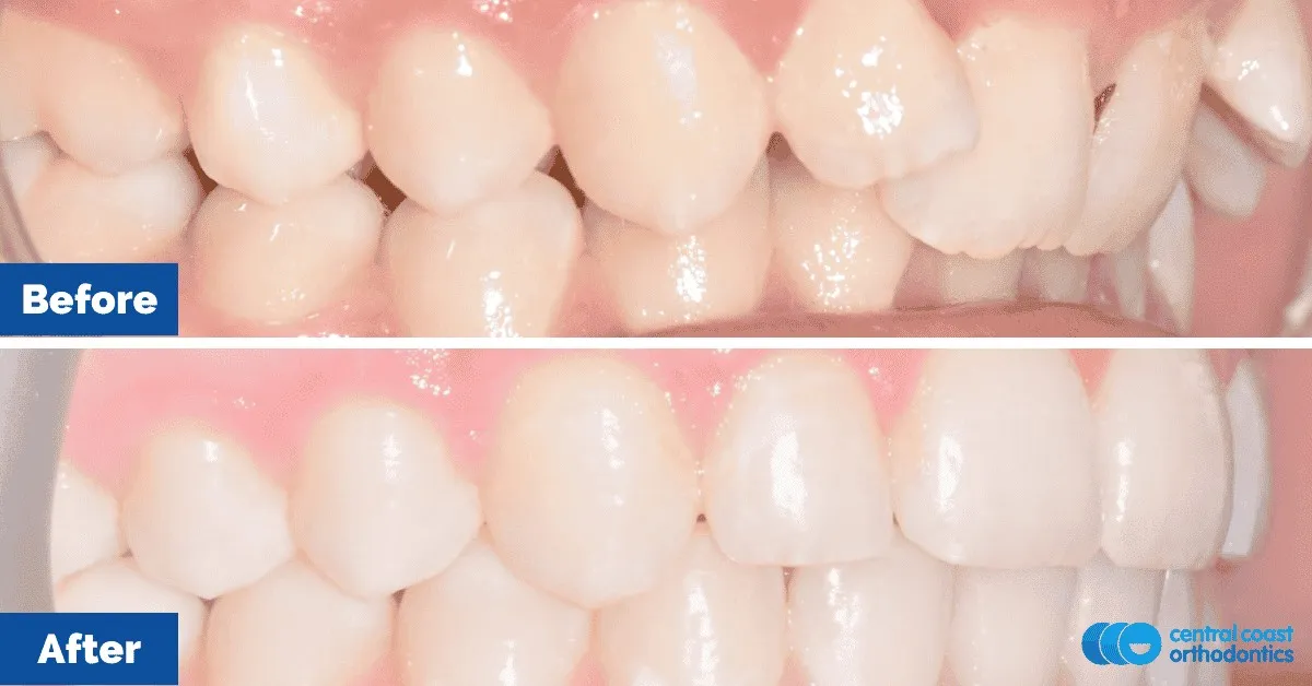 Before and after comparison, side view of the upper and lower teeth