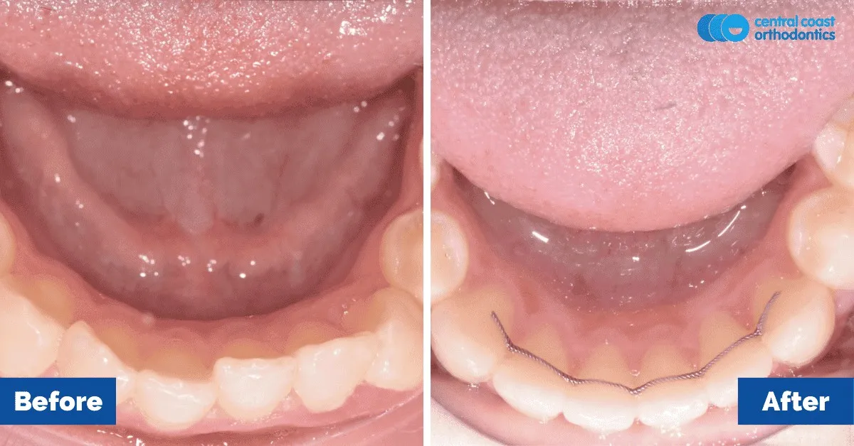 Before and after comparison, lower teeth viewed from above