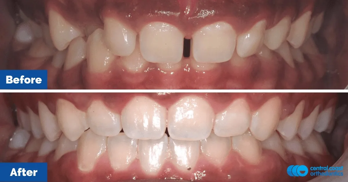 Before and after comparison, front view of the upper and lower teeth