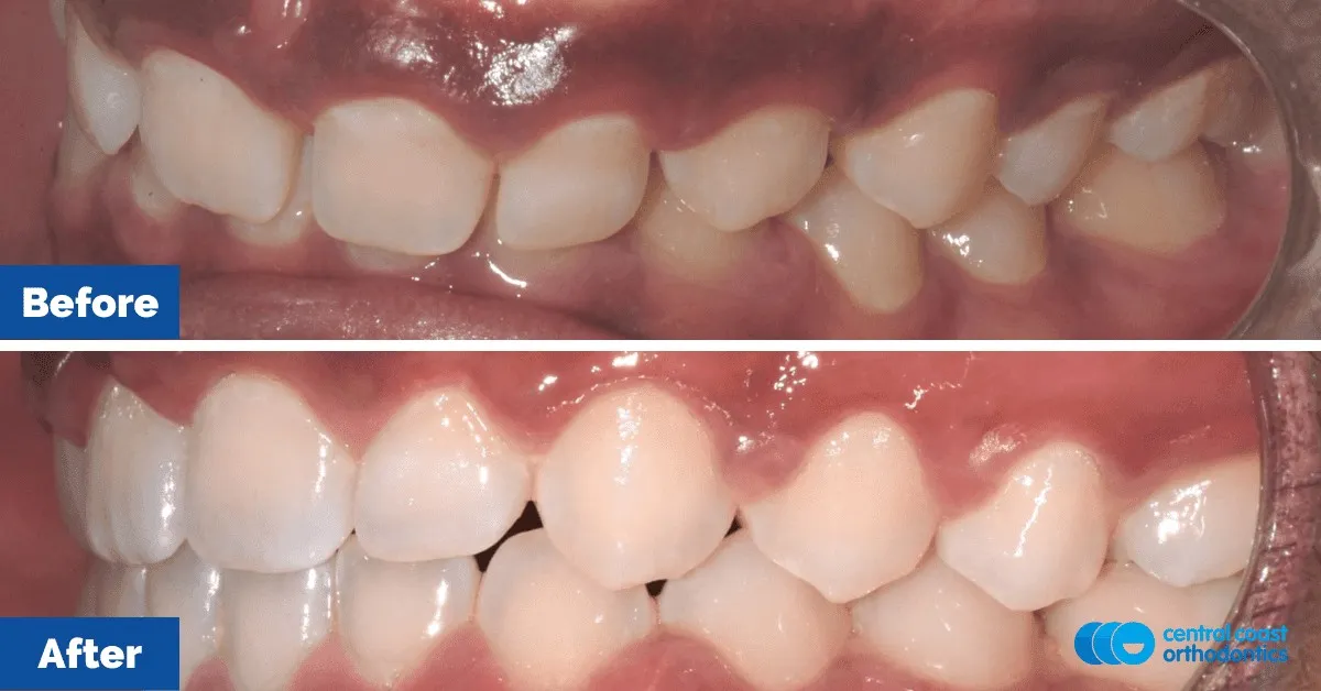 Before and after comparison, side view of the upper and lower teeth