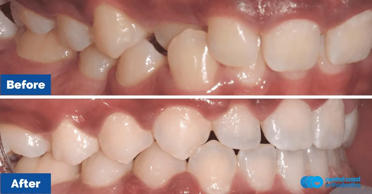 Before and after comparison, front view of the upper and lower teeth