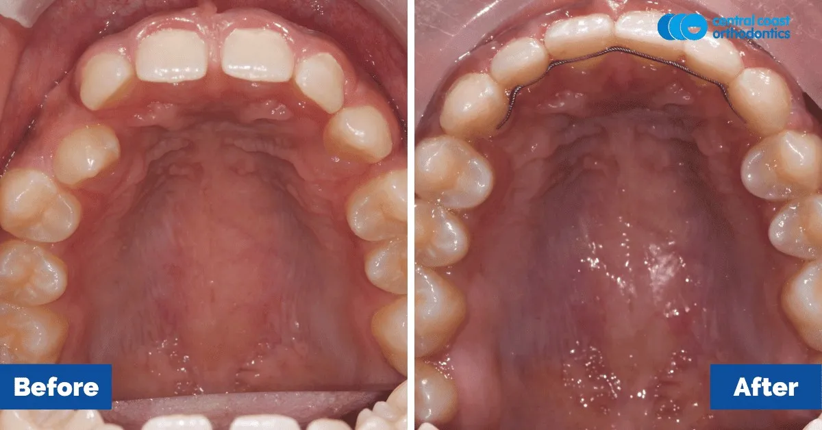Before and after comparison, upper teeth viewed from below