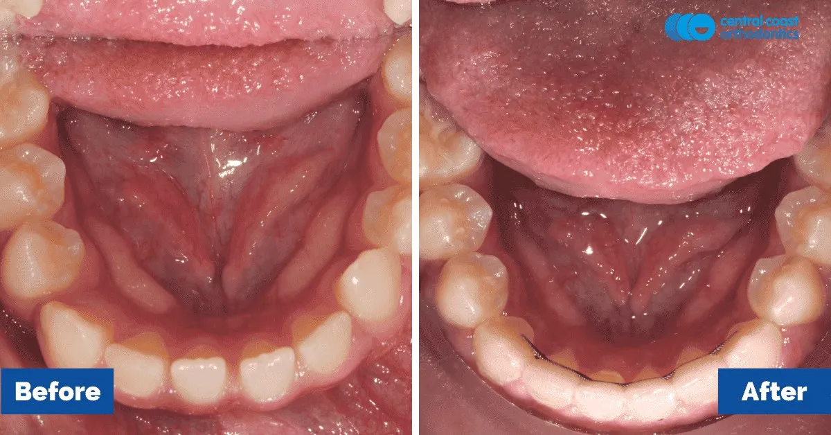 Before and after comparison, lower teeth viewed from above