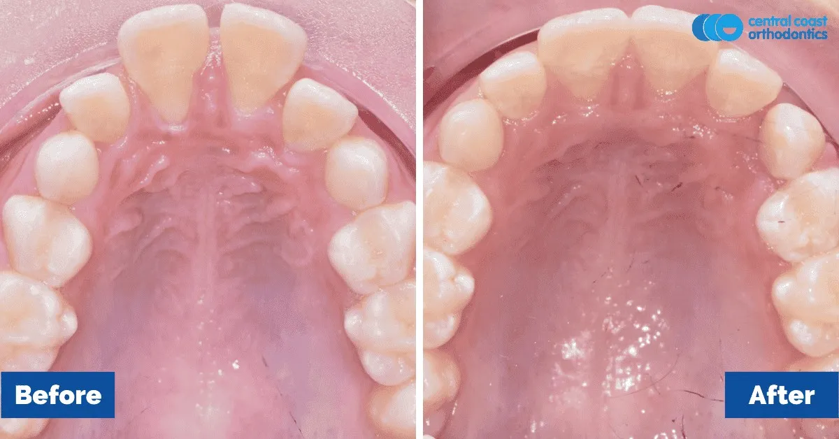 Before and after comparison, upper teeth viewed from below