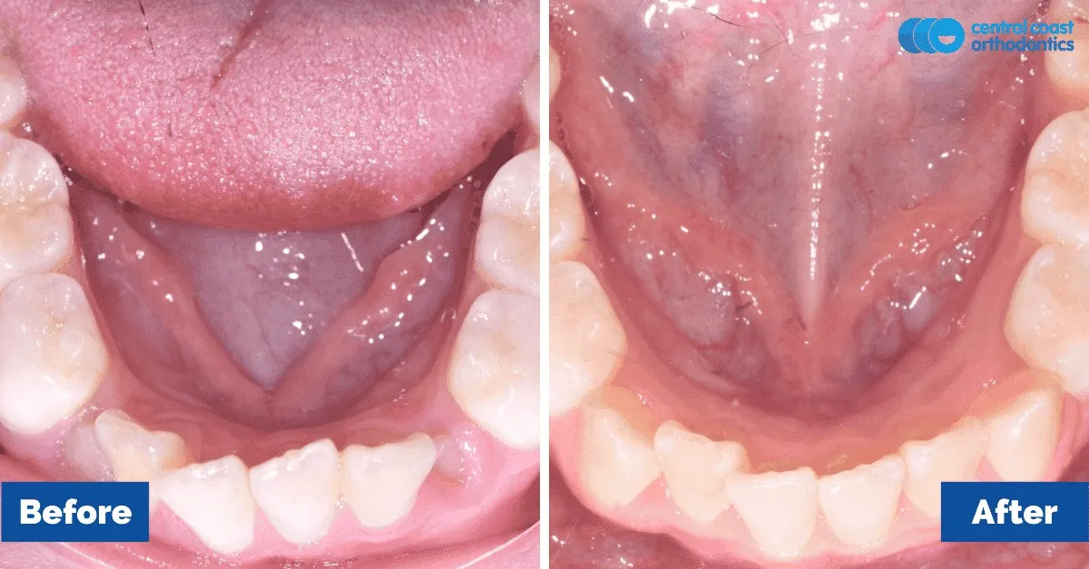 Before and after comparison, lower teeth viewed from above