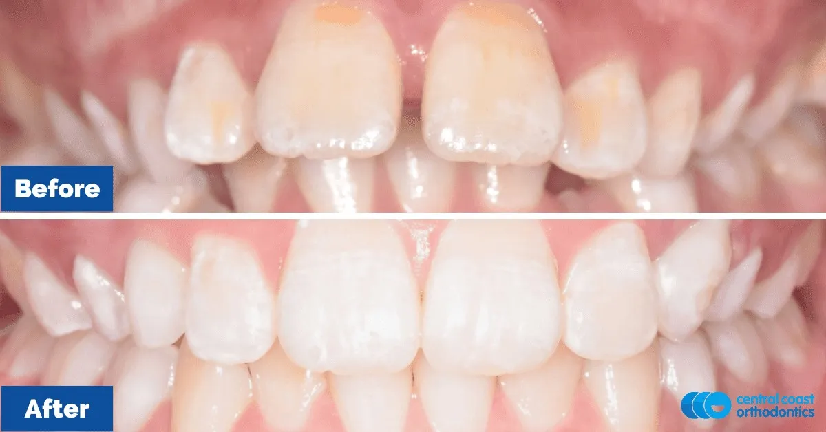 Before and after comparison, front view of the upper and lower teeth