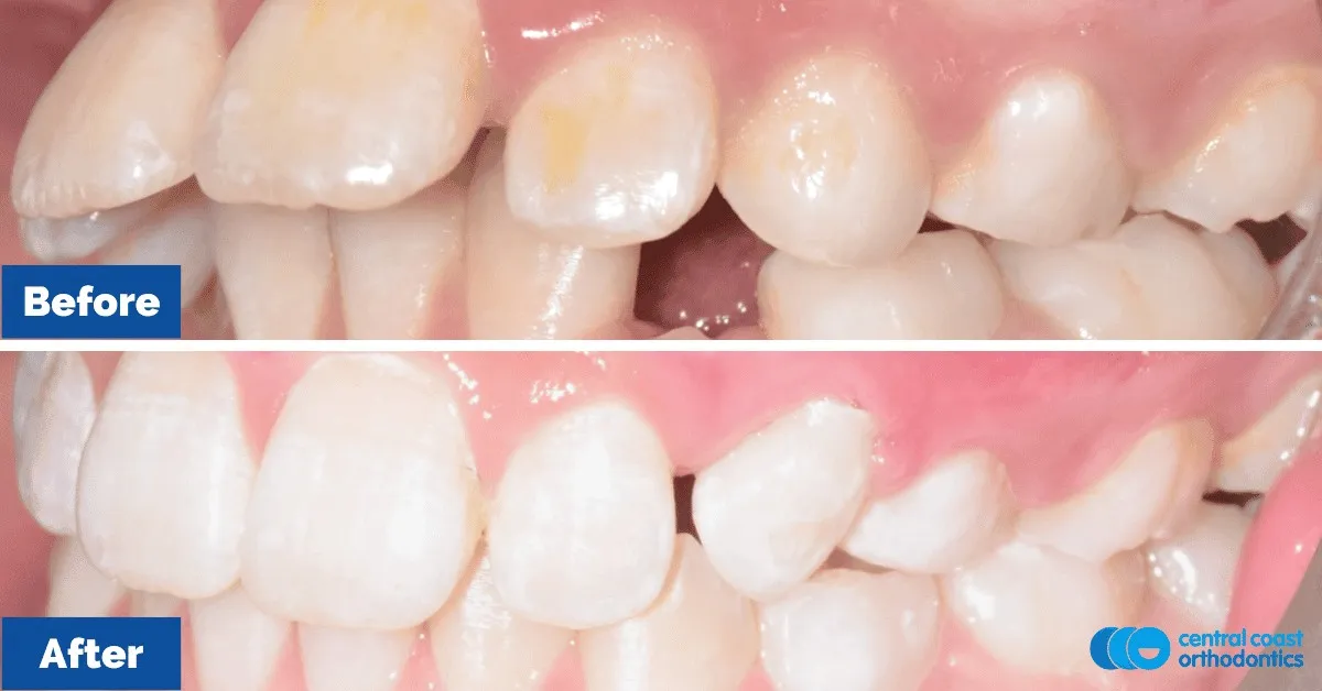 Before and after comparison, side view of the upper and lower teeth
