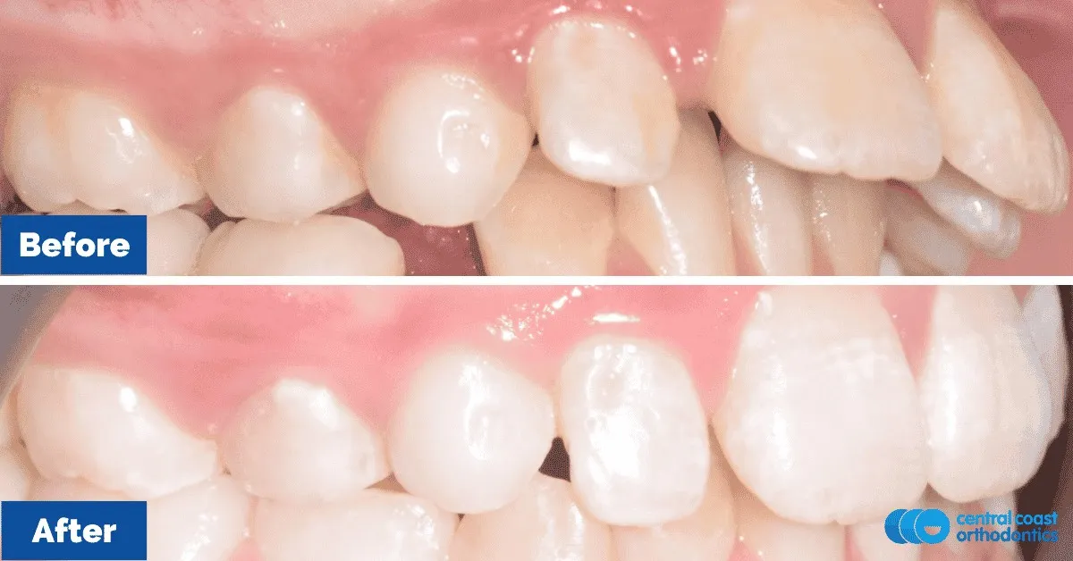 Before and after comparison, side view of the upper and lower teeth