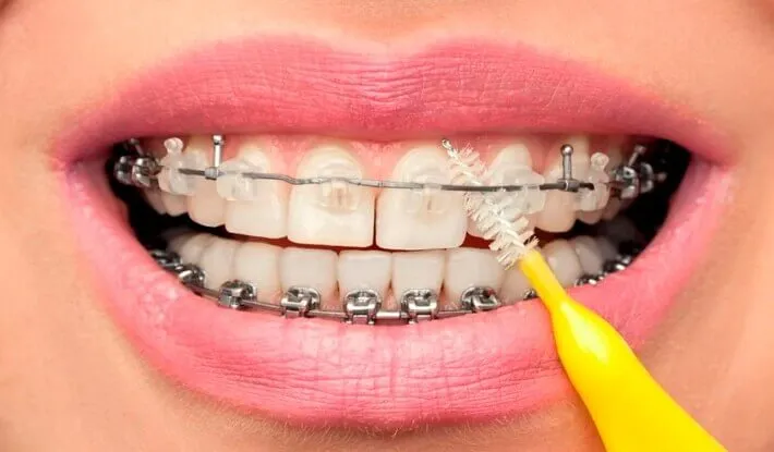 Close-up of an interdental brush cleaning between braces brackets