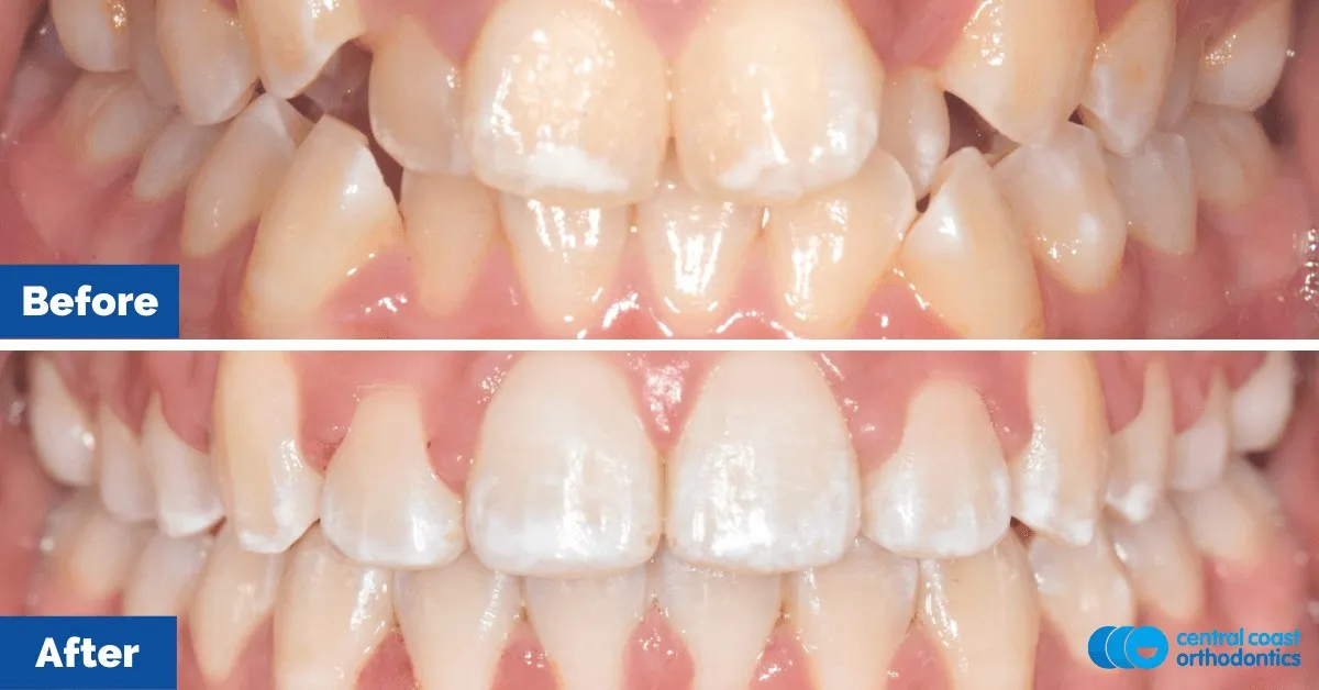 Before and after comparison, front view of the upper and lower teeth