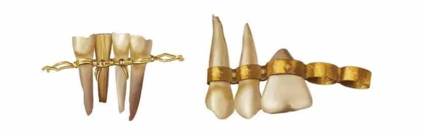 Ancient gold dental appliances shown against a plain background