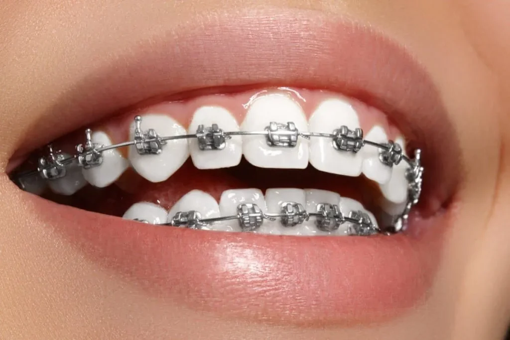 Close-up of a smile with metal braces on the upper and lower teeth