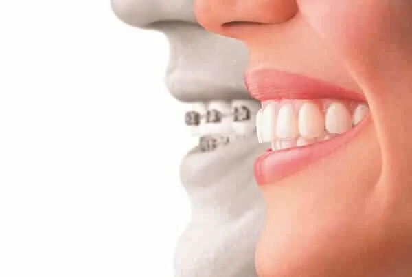 Side view of teeth fitted with metal braces, lips drawn back