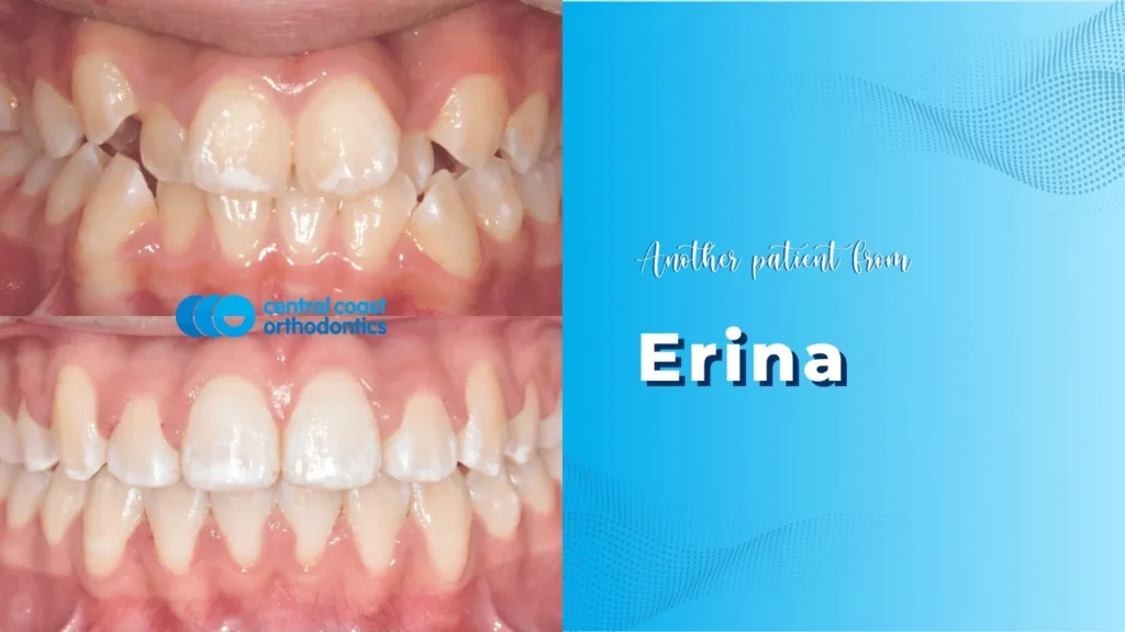 Orthodontic Journey in Erina