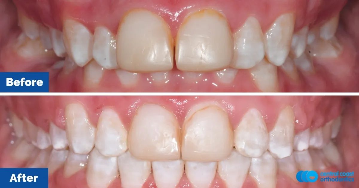 Before and after comparison, front view of the upper and lower teeth