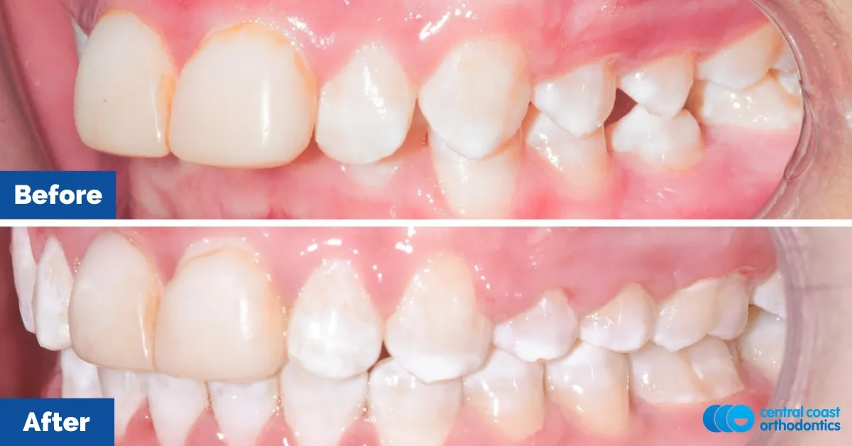 Before and after comparison, side view of the upper and lower teeth