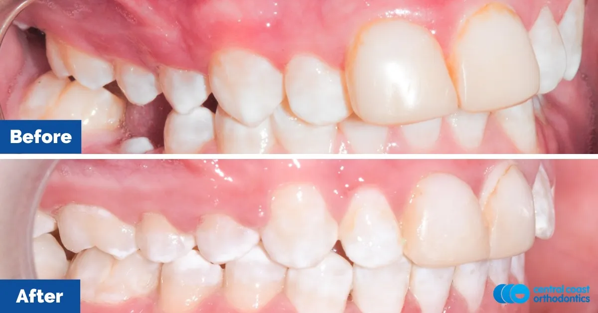 Before and after comparison, side view of the upper and lower teeth