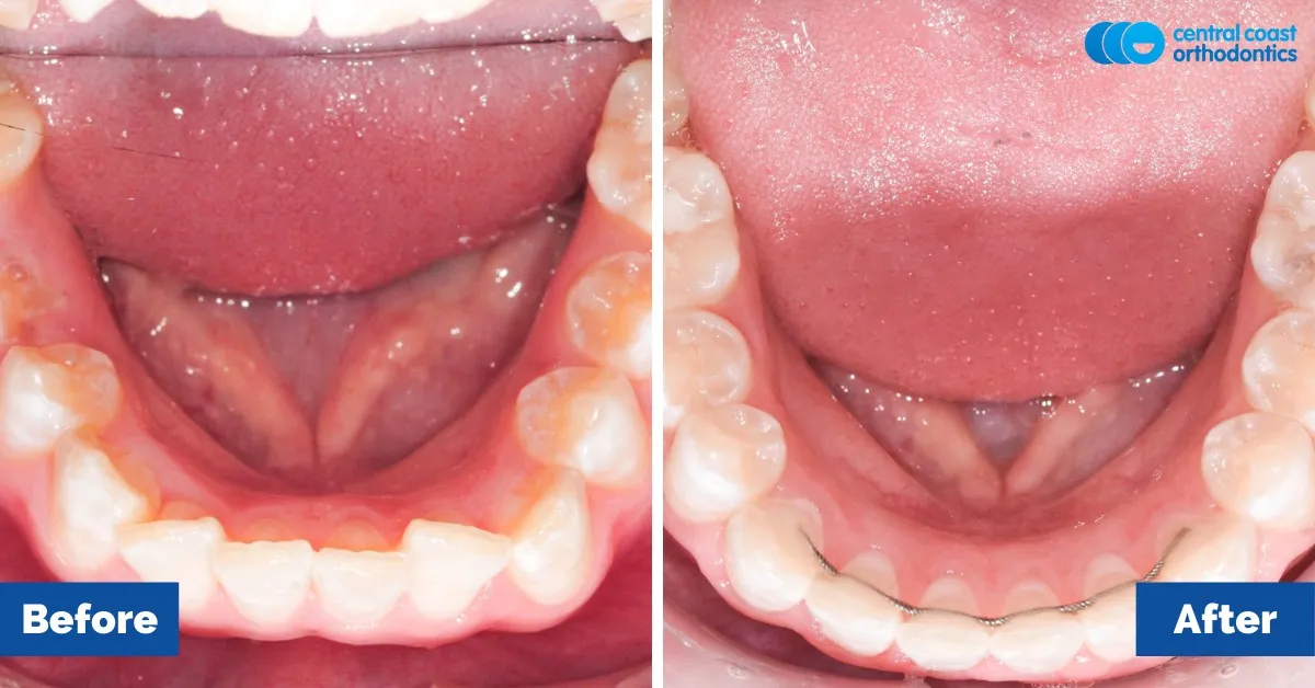 Before and after comparison, lower teeth viewed from above