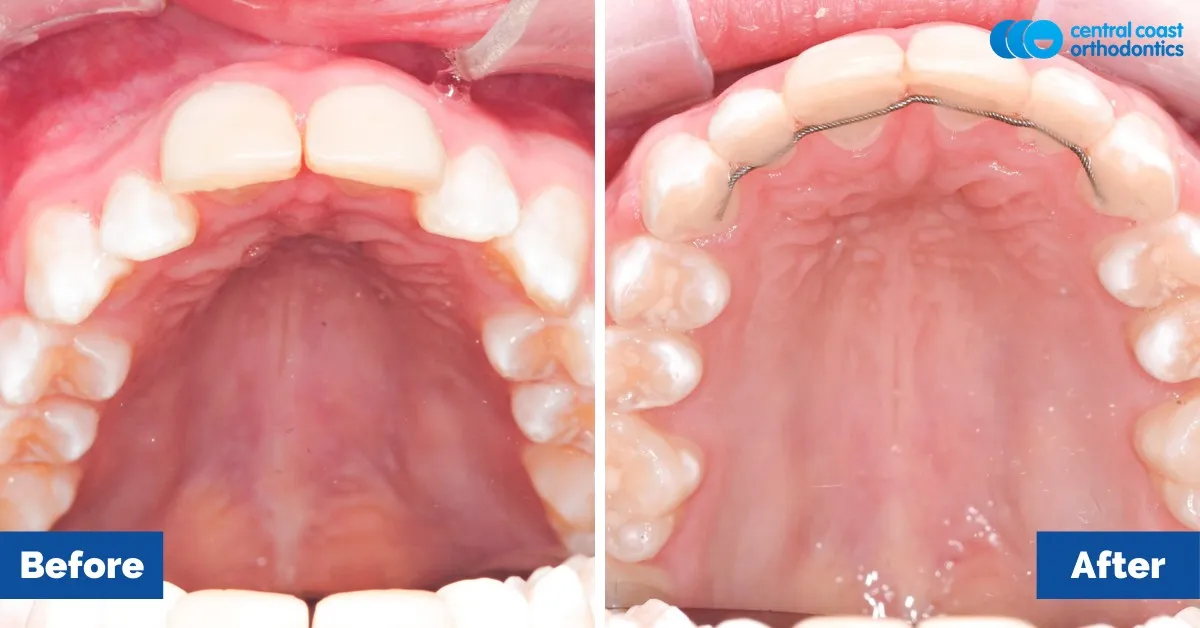 Before and after comparison, upper teeth viewed from below