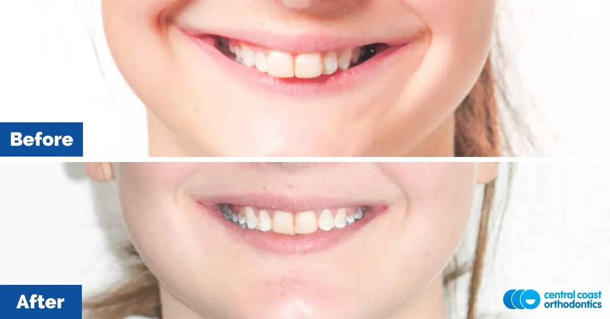 Before and after comparison of the patient's smile