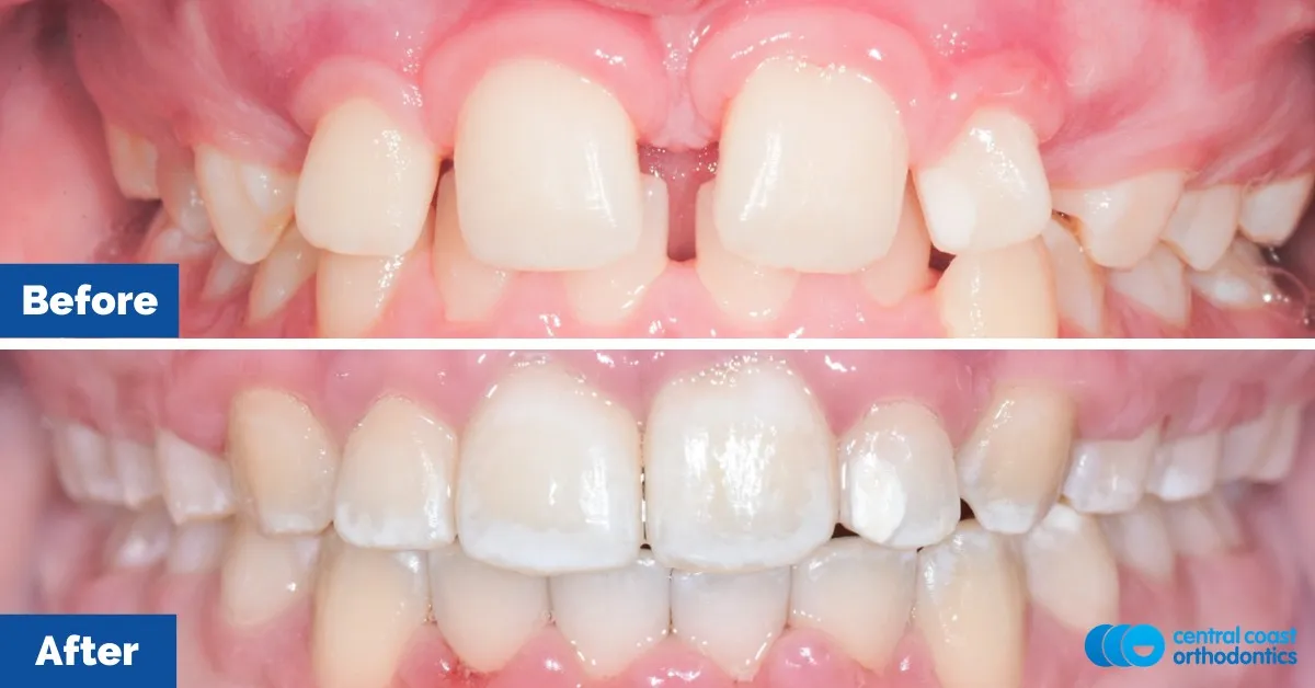 Before and after comparison, front view of the upper and lower teeth