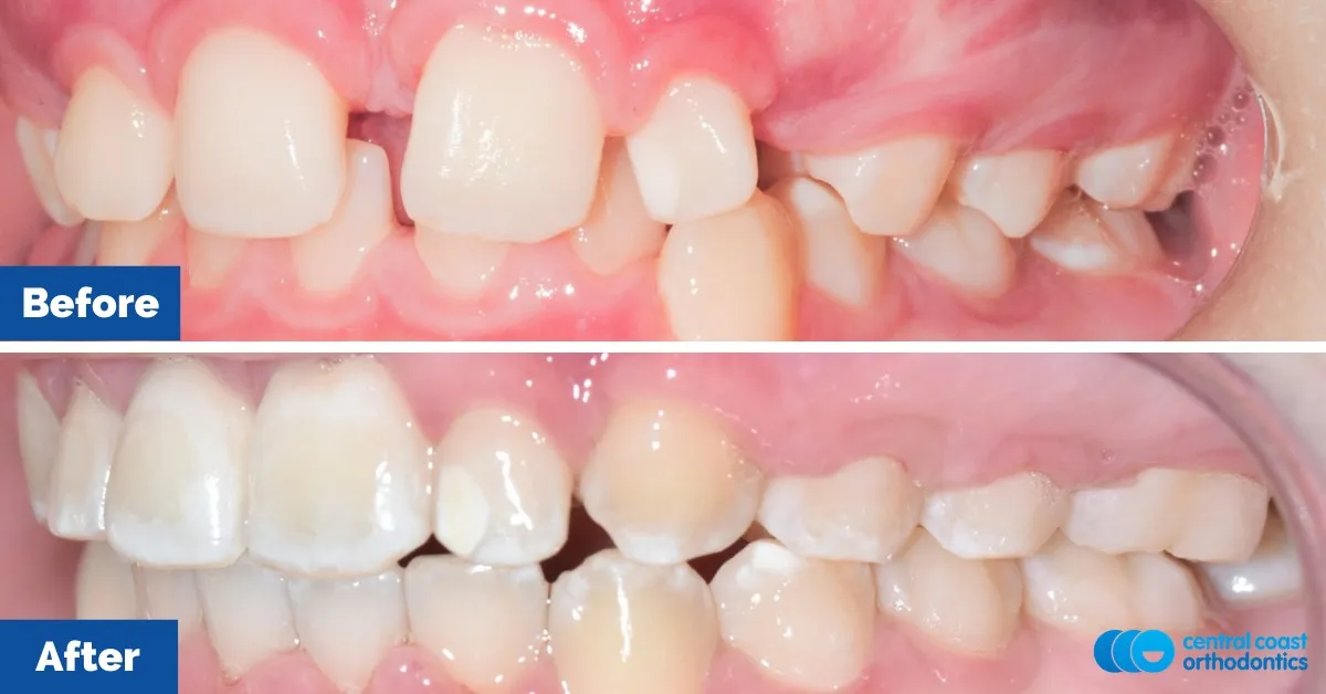Before and after comparison, front view of the upper and lower teeth