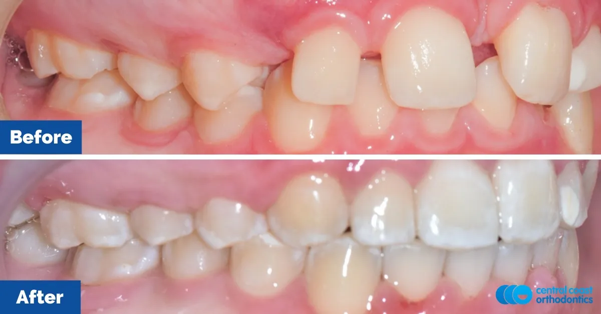Before and after comparison, side view of the upper and lower teeth