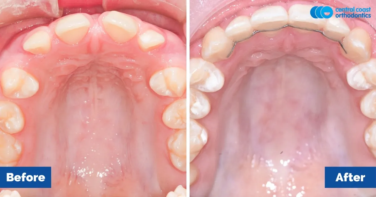 Before and after comparison, upper teeth viewed from below