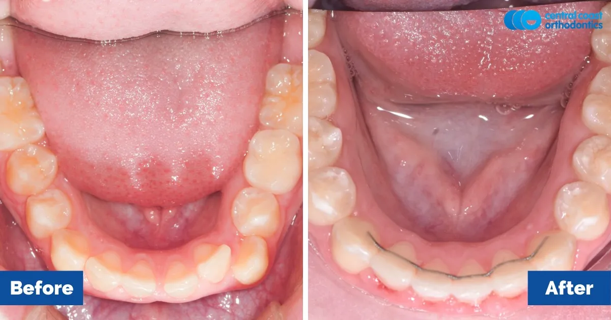 Before and after comparison, lower teeth viewed from above