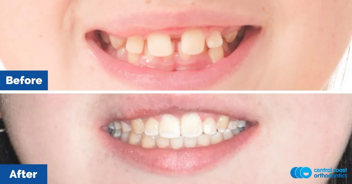 Before and after comparison of the patient's smile