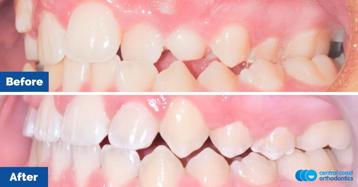 Before and after comparison, side view of the upper and lower teeth