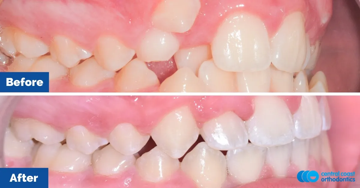 Before and after comparison, side view of the upper and lower teeth